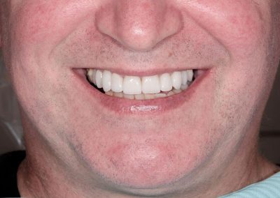 Implants and Porcelain Crowns