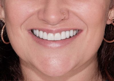 Implants and Porcelain Crowns